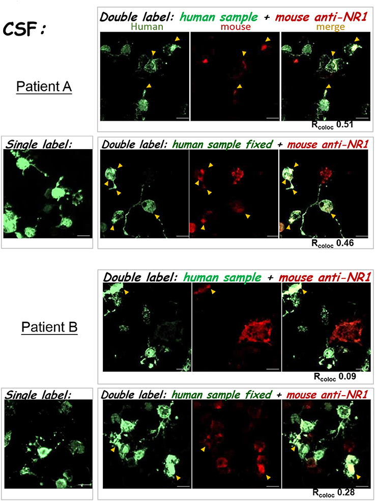 nmda lab test