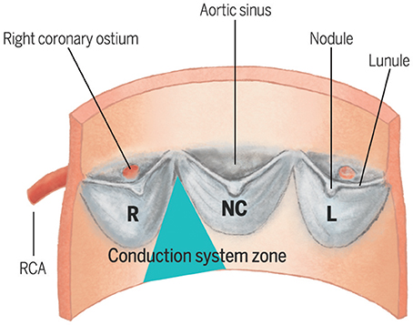 Incidence and predictors of developing high-degree AV block in patients