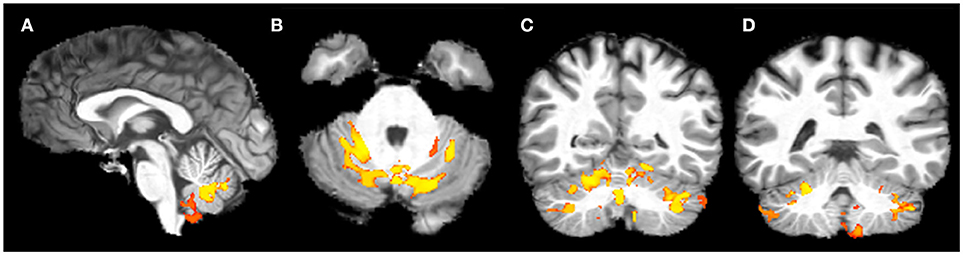 interventional radiology meeting human brain mapping interventional radiology meeting human brain mapping