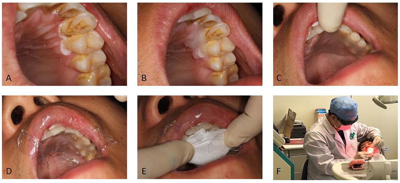 Frontiers Primary Clinical Evaluation Of Photodynamic Therapy With