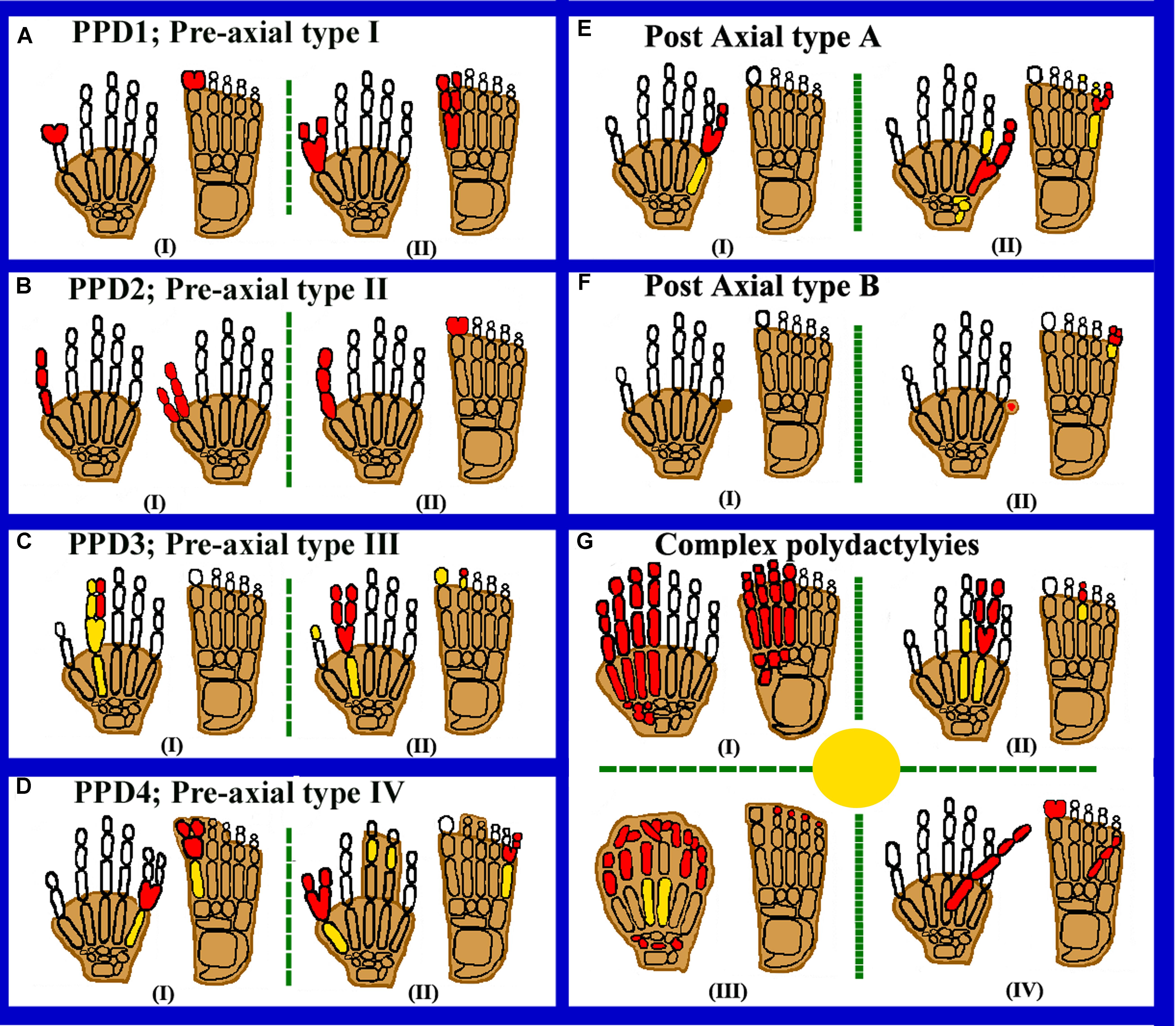 Frontiers  Clinical Genetics of Polydactyly: An Updated Review