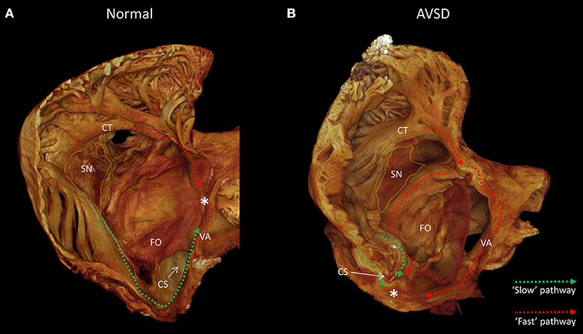 Frontiers | Morphological Substrates for Atrial Arrhythmogenesis in a Heart  With Atrioventricular Septal Defect