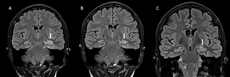 Frontiers | Clinical Management of Epilepsy With Glutamic Acid ...