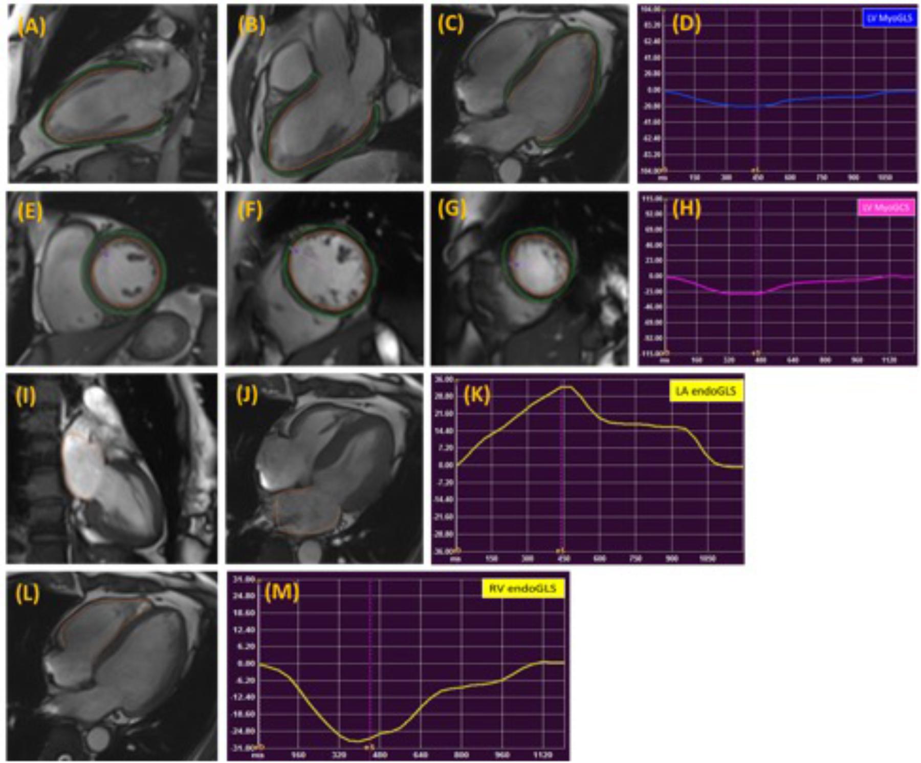 Myocardial strain assessed by feature tracking cardiac magnetic