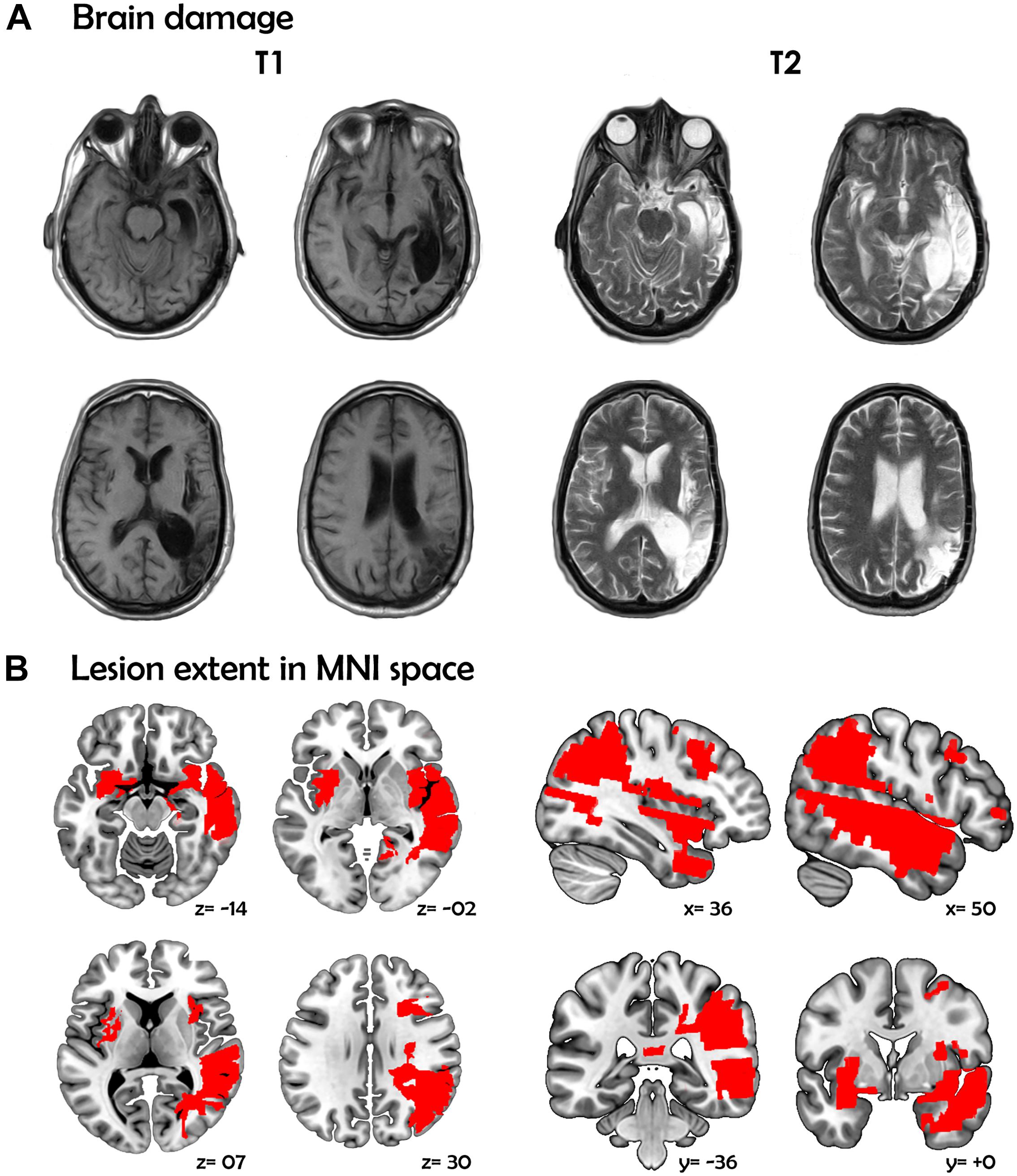 Frontiers | Rethinking the Neural Basis of Prosody and Non-literal