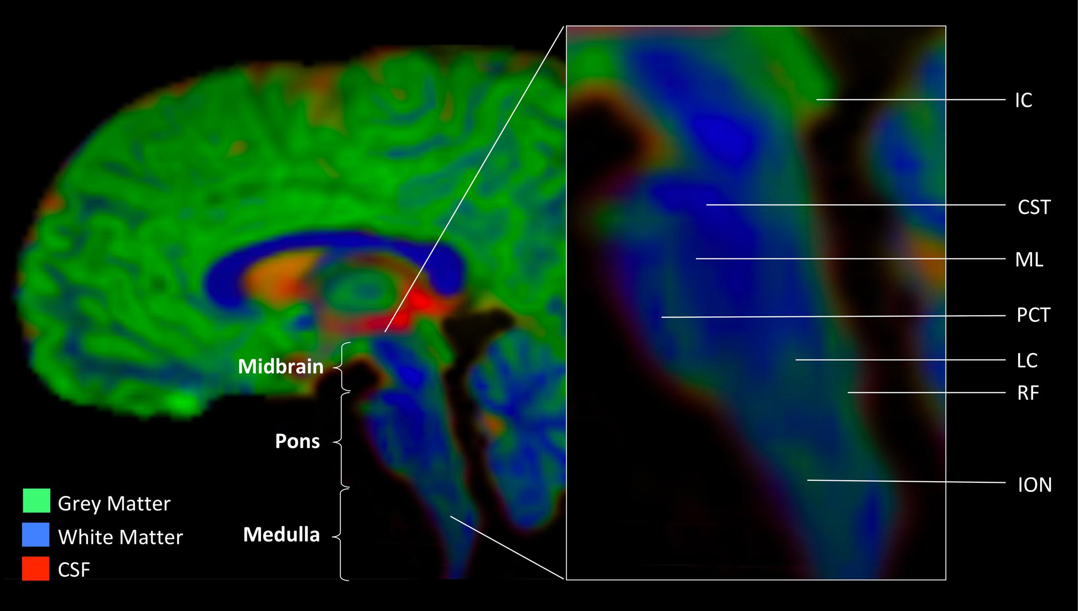 Frontiers Evidence For Brainstem Contributions To Autism Spectrum Disorders Frontiers In Integrative Neuroscience