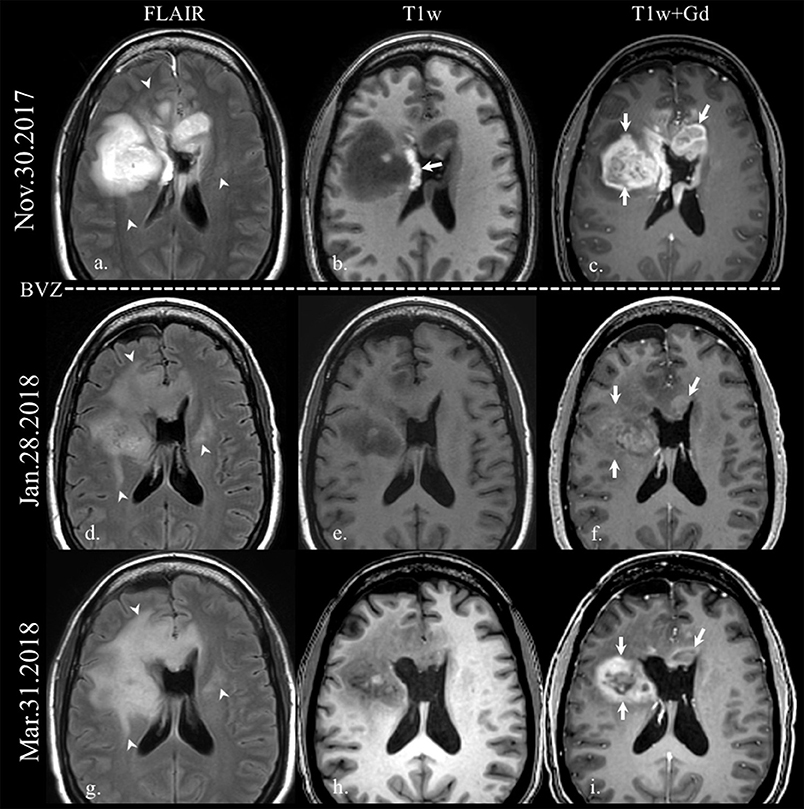 Frontiers  Specific imaging features indicate the clinical