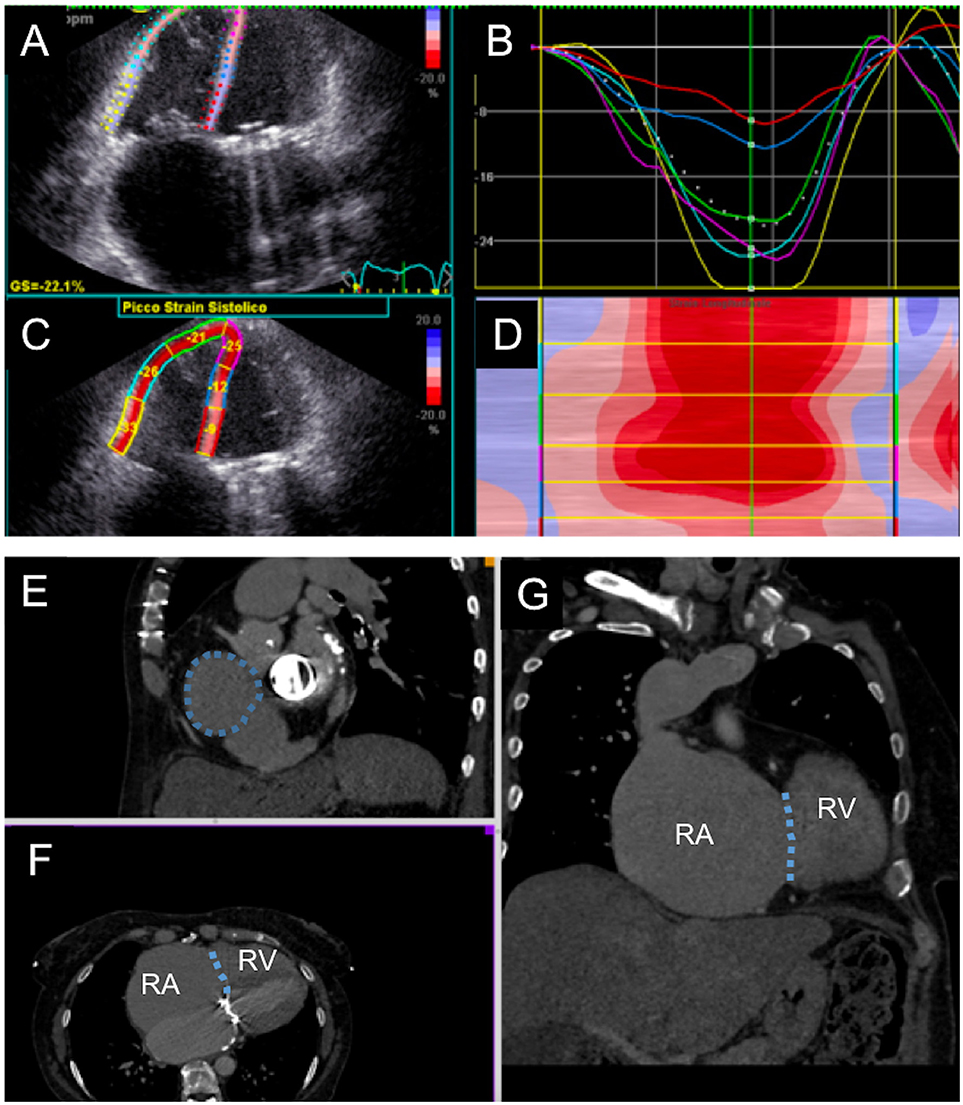 Frontiers Transcatheter Tricuspid Valve Replacement Principles And