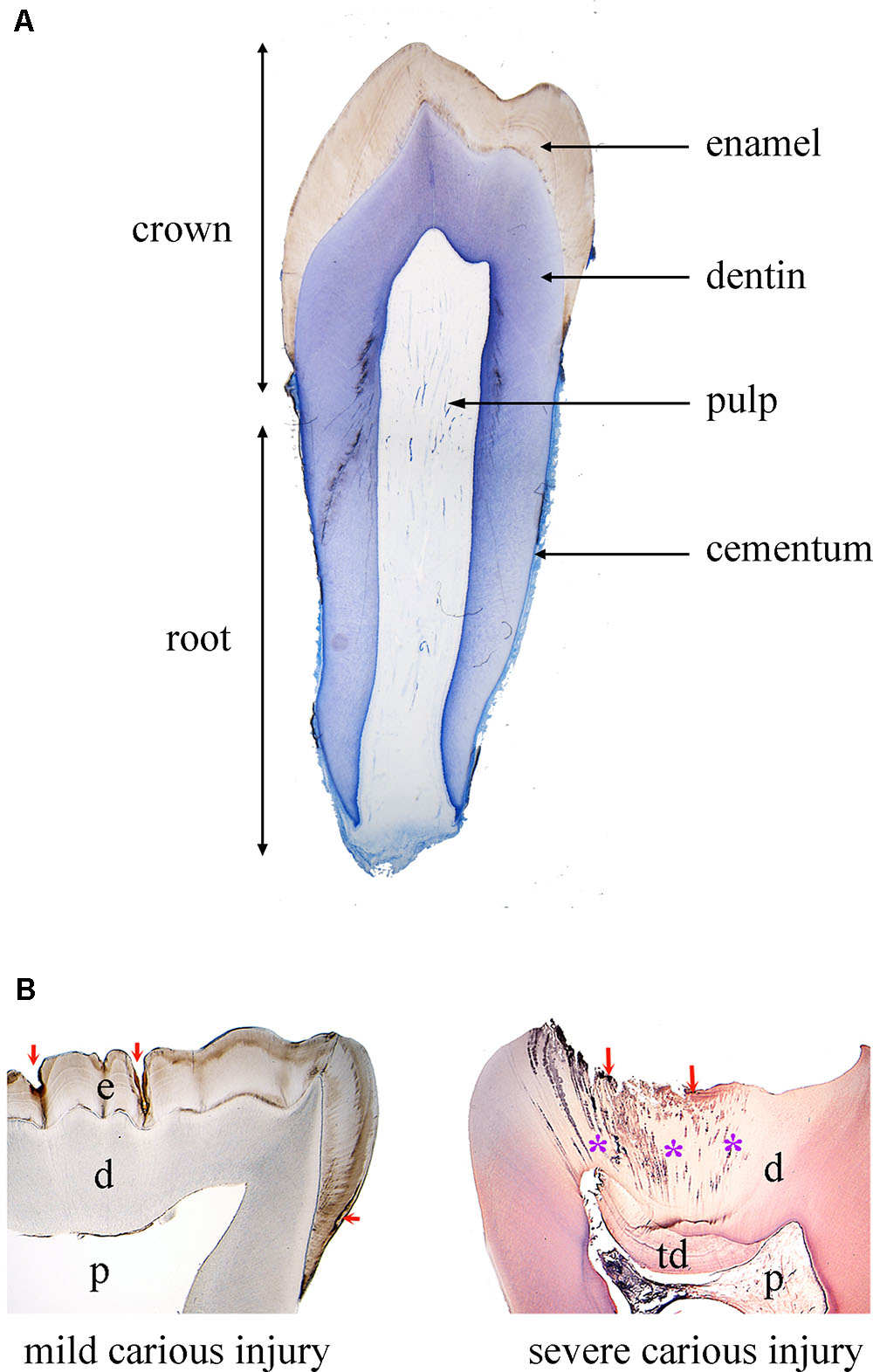 Resin Bonding of upper two front teeth - Carroll Dental Care