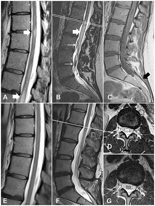 Frontiers | Coincidence of Tethered Cord, Filum Terminale Lipoma