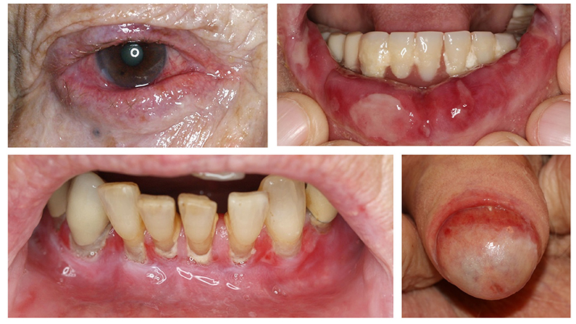 Frontiers Diagnosis Of Autoimmune Blistering Diseases