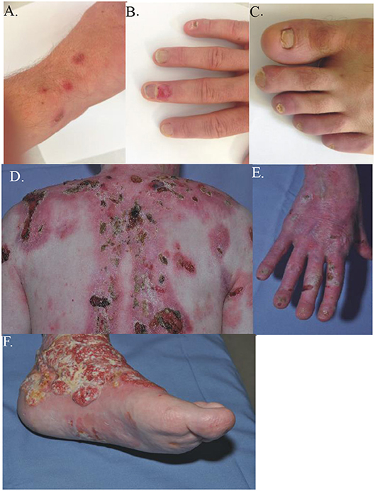 Frontiers  Epidermolysis Bullosa Acquisita: The 2019 Update