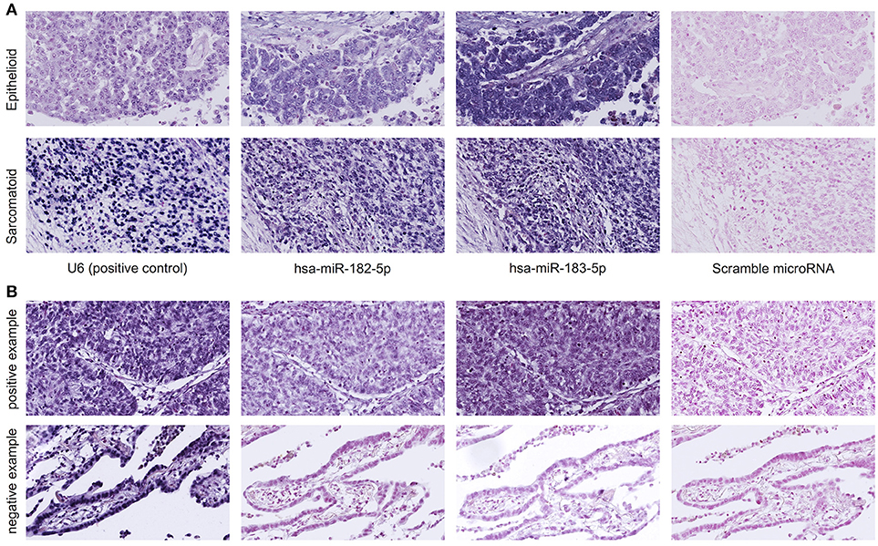 do you need a biopsy to confirm cancer