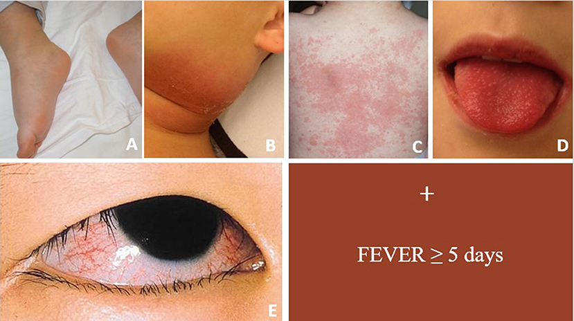 Frontiers How Should We Classify Kawasaki Disease? | Immunology