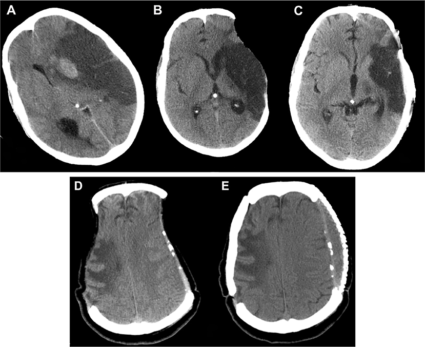 Frontiers | Complications of Decompressive Craniectomy