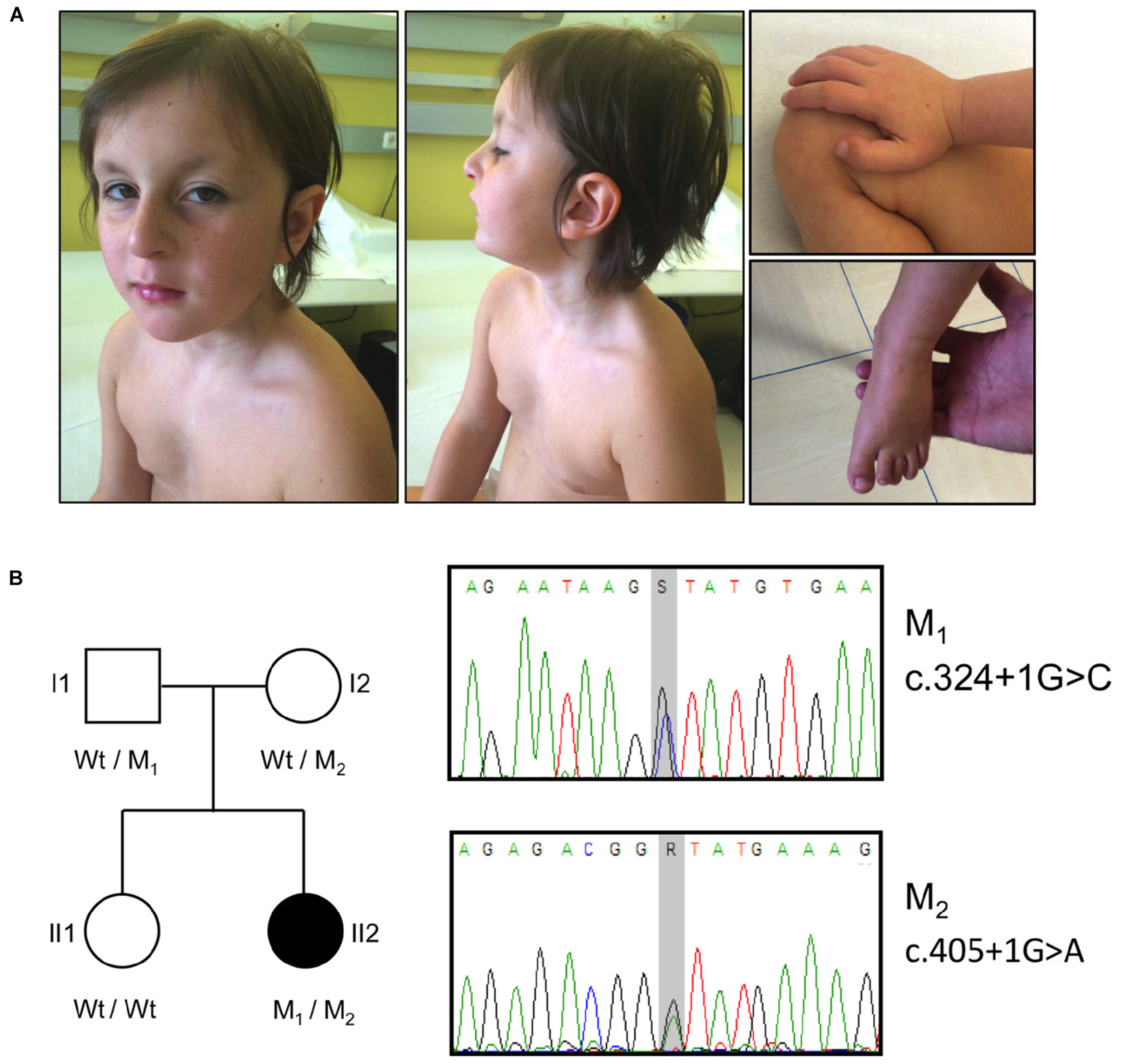 A Case of Rubinstein-Taybi Syndrome with Tetralogy of Fallot