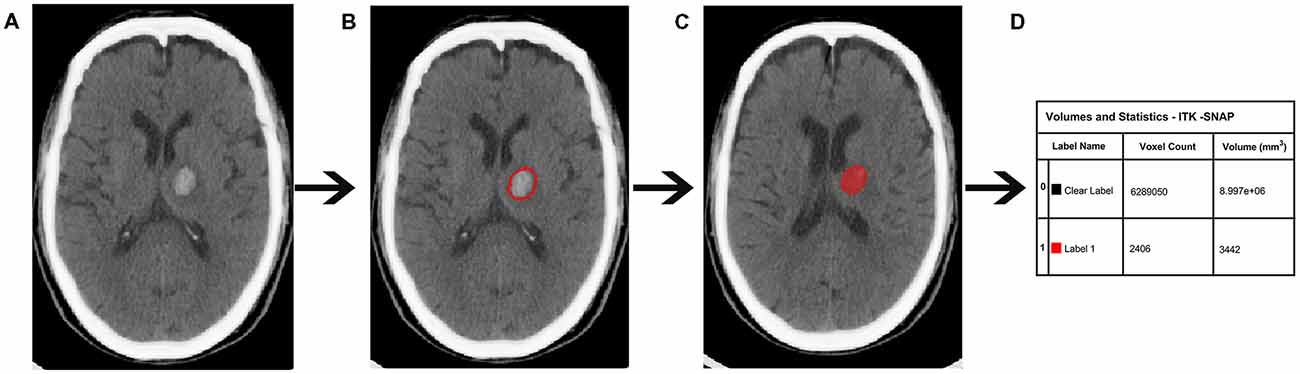 Frontiers | The Impact of Intracerebral Hemorrhage on the Progression ...