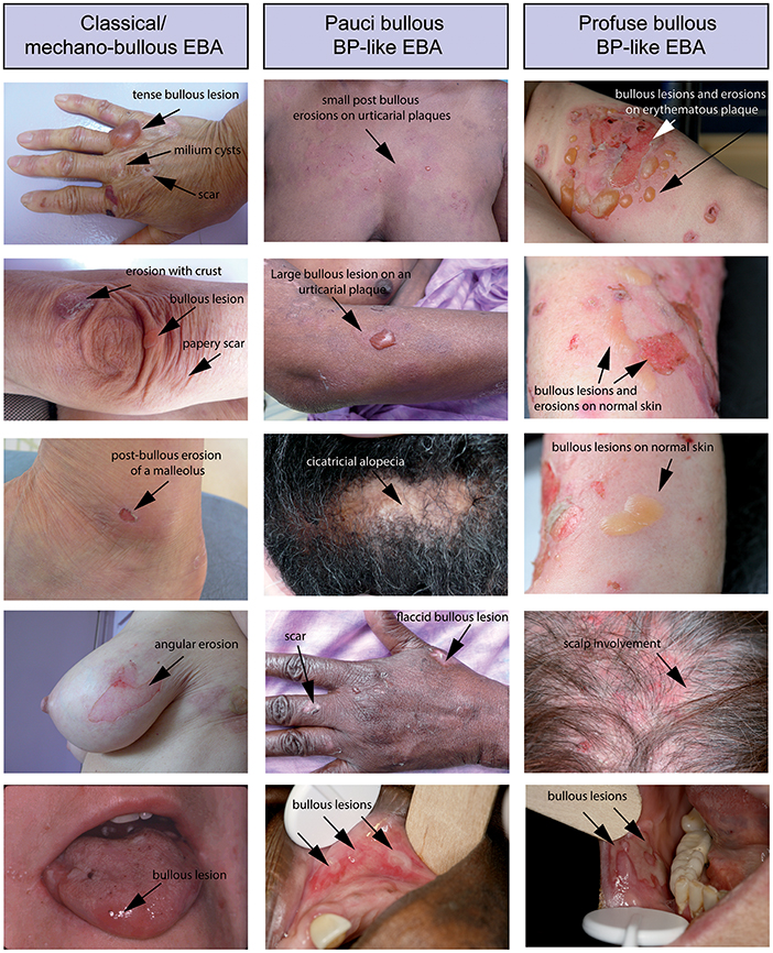 | Epidermolysis Bullosa Acquisita: The 2019 Update