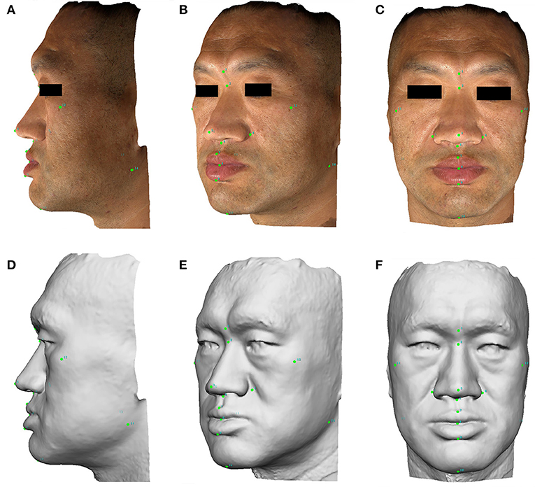 Acromegaly Progression