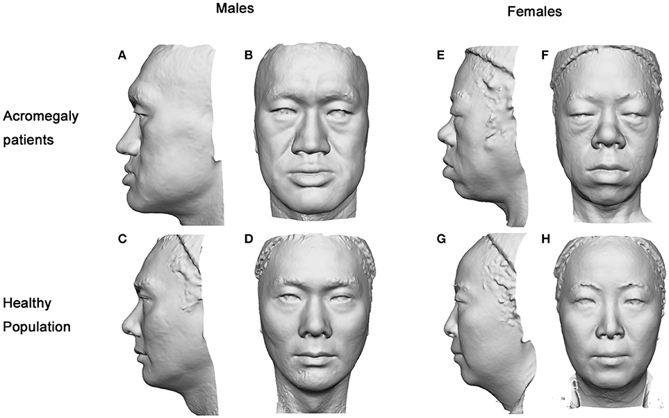 Frontiers | 3D Facial Analysis in Acromegaly: Gender-Specific Features ...