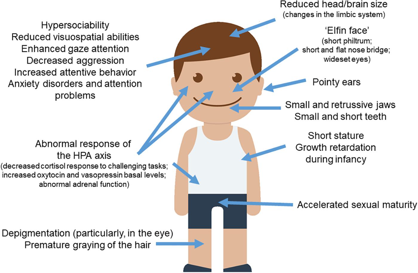 Williams Syndrome Eyes