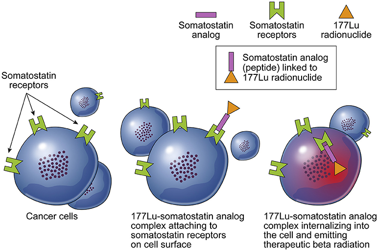 neuroendocrine cancer prrt treatment