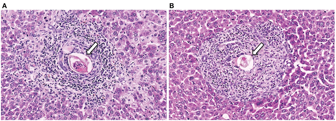 schistosomiasis granuloma formation