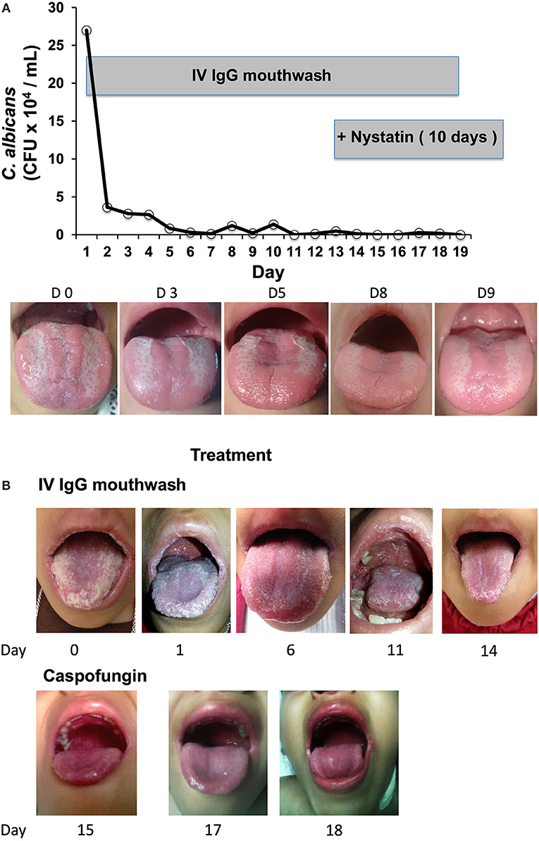 Oral Candidiasis Treatment