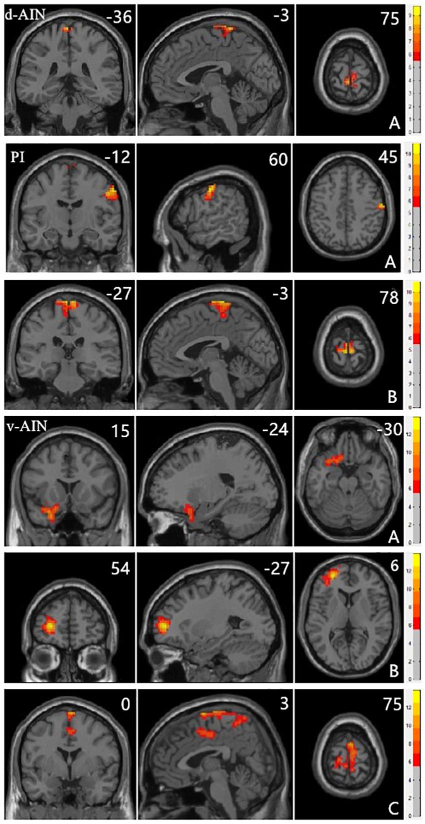 Frontiers  Neural activity in adults with major depressive disorder  differs from that in healthy individuals: A resting-state functional  magnetic resonance imaging study