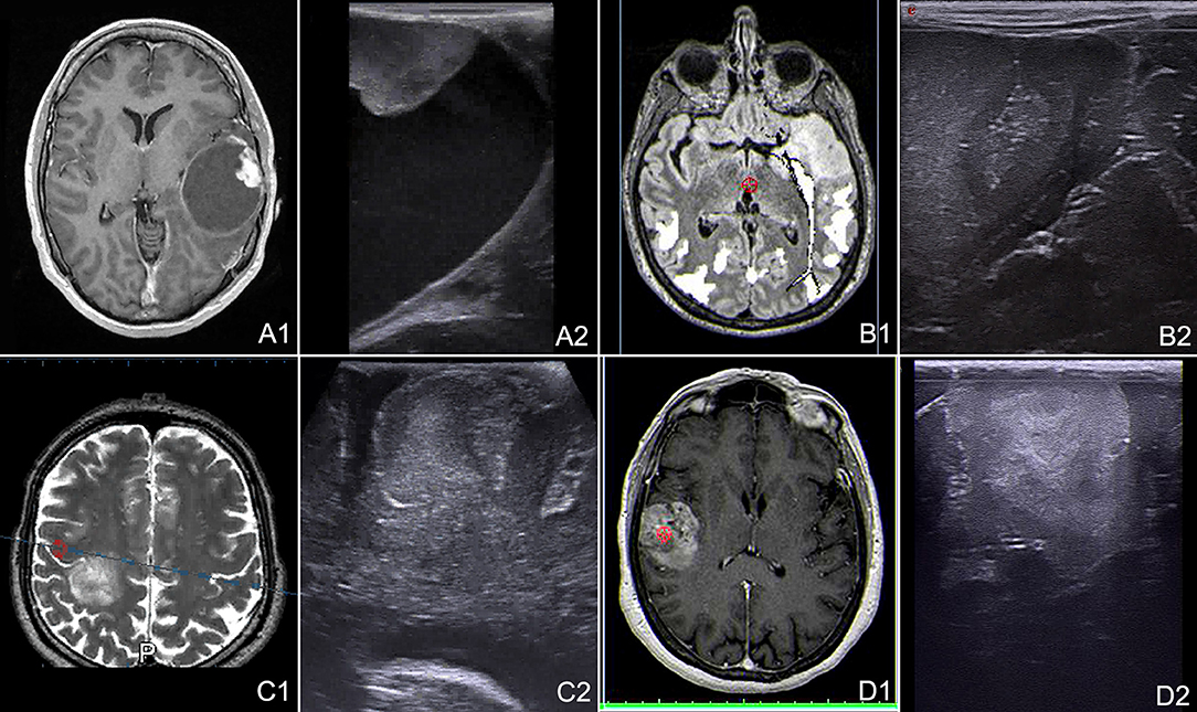 Ultrasound imaging in B-mode, color and spectral Doppler of the