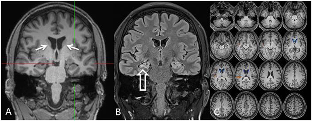 Frontiers | Chorea-Acanthocytosis Presenting as Autosomal Recessive ...