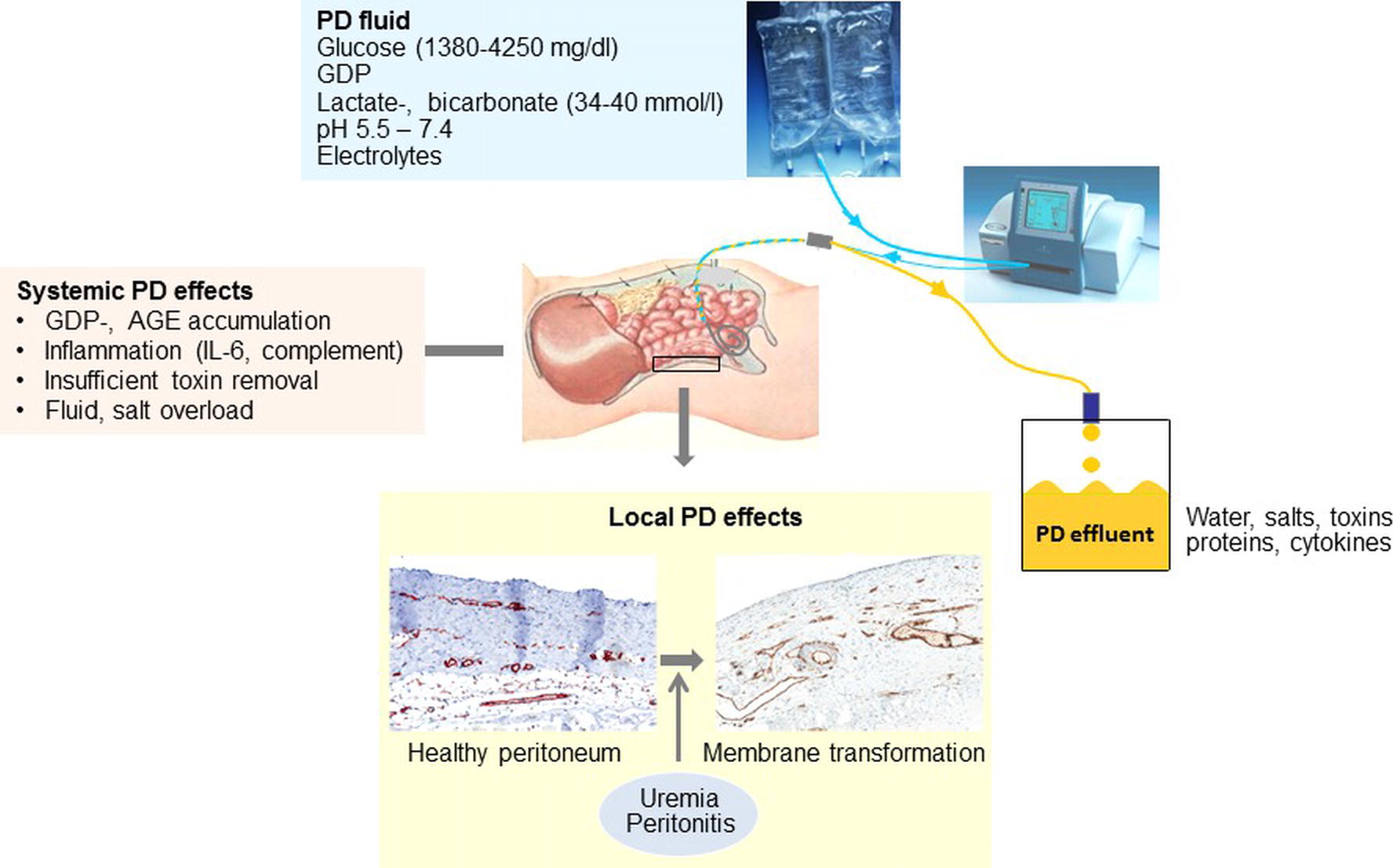 Details more than 63 peritoneal dialysis fluid bags latest ...