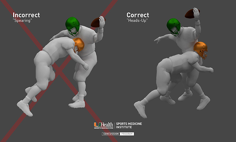 Figure 3 - The figure shows two football tackling techniques: spearing and heads-up.