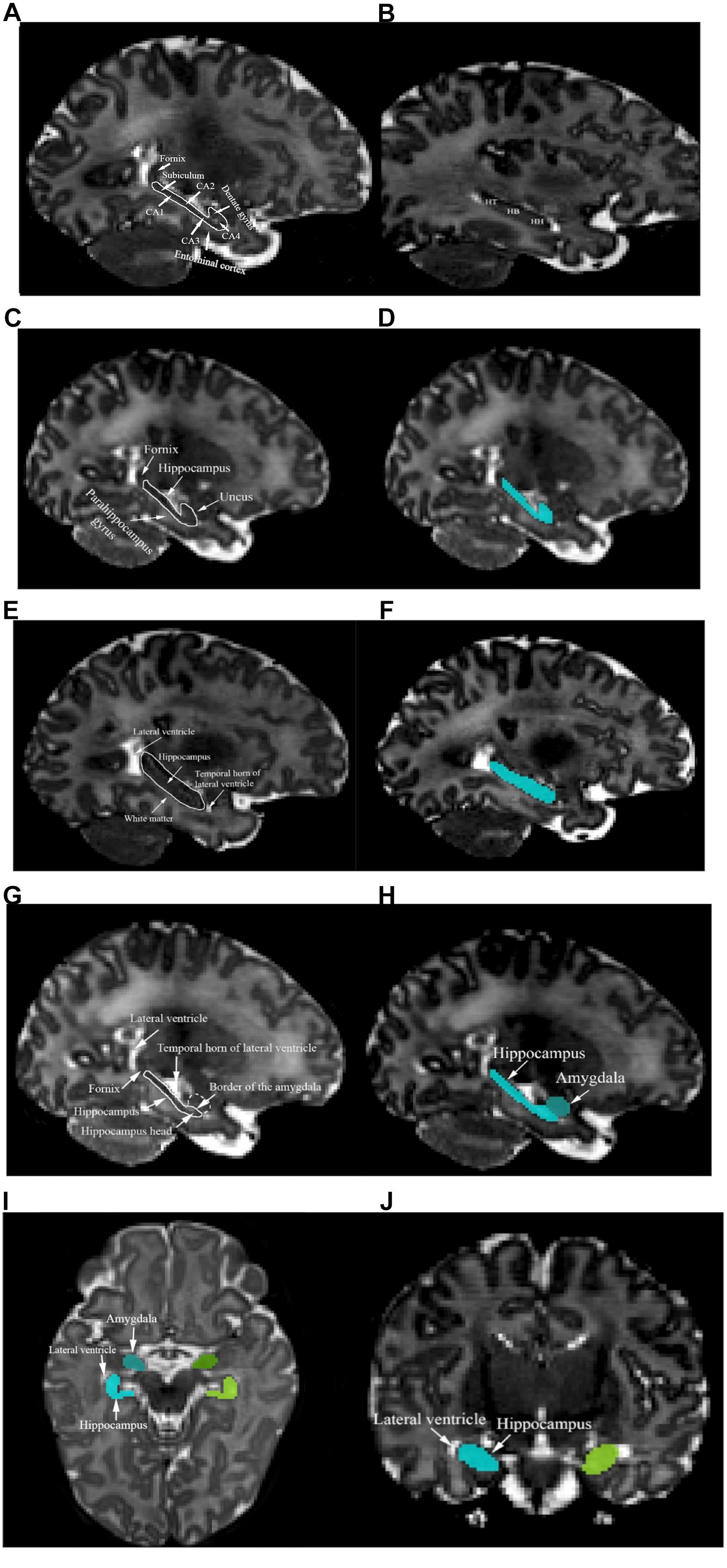 hippocampus anatomy landmarks