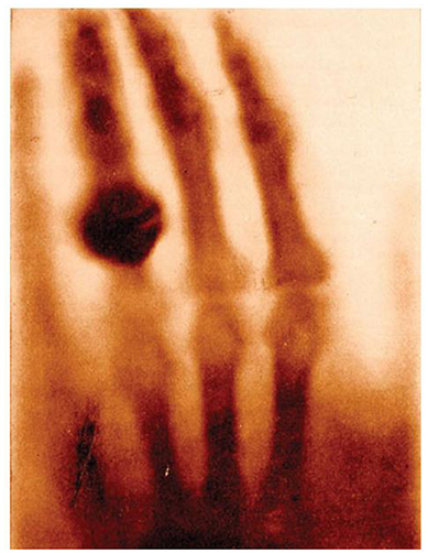 Figure 1 - An X-ray of the hand of Anna Ludwig taken on 22 December 1895 by her husband Wilhelm Röntgen.