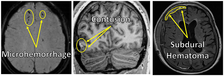 Figure 3 - MRI images of brain injuries.