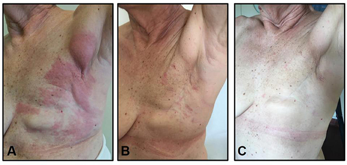 Frontiers  Exceptional and Durable Responses to TDM-1 After Trastuzumab  Failure for Breast Cancer Skin Metastases: Potential Implications of an  Immunological Sanctuary