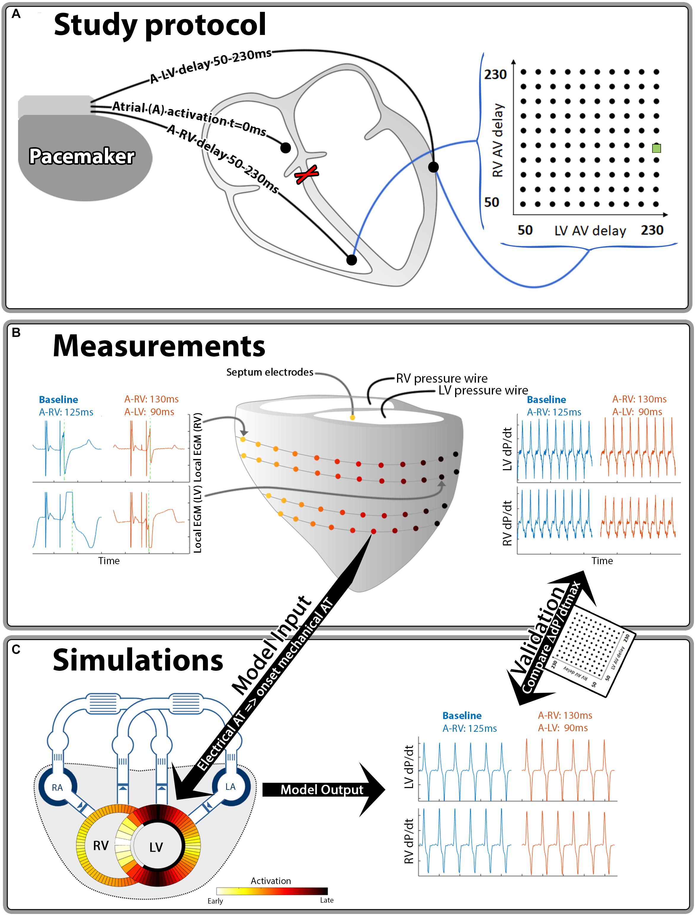 Optimization of the AV delay in a patient with complete AV block