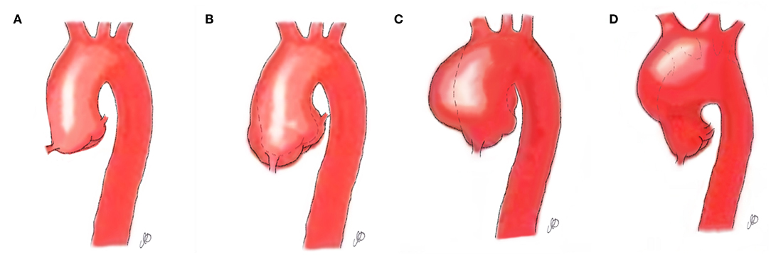Frontiers Evolving Surgical Approaches To Bicuspid Aortic Valve