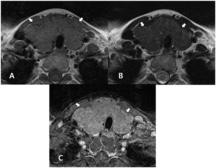 thyroiditis radiology