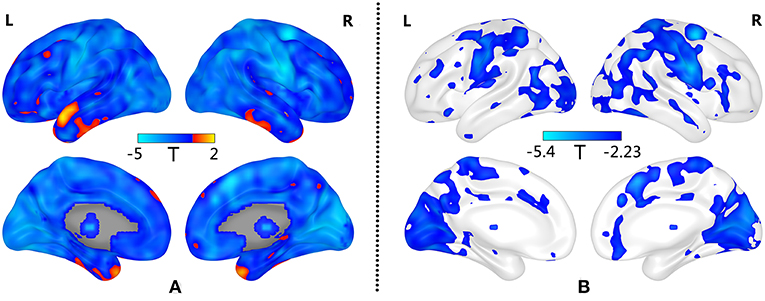 anxiety disorder brain