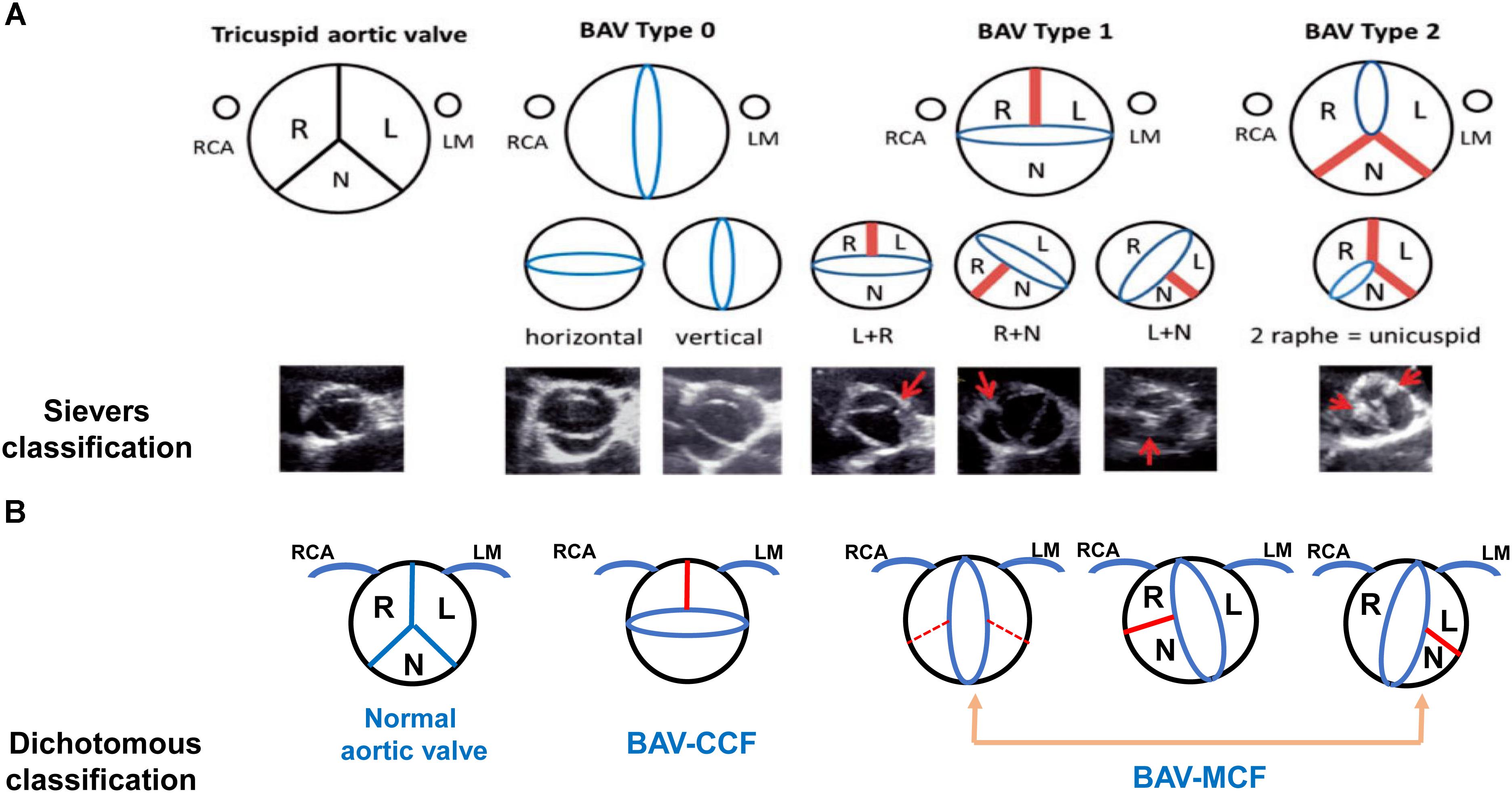 Frontiers Bicuspid Aortic Valve An Update In Morphology Genetics Biomarker Complications