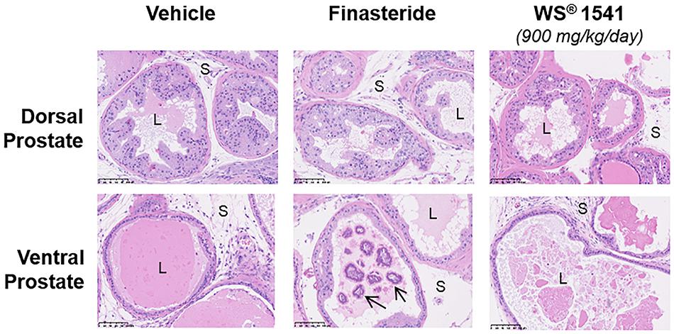 Is finasteride contraindicated in prostate cancer Is finasteride contraindicated in prostate cancer