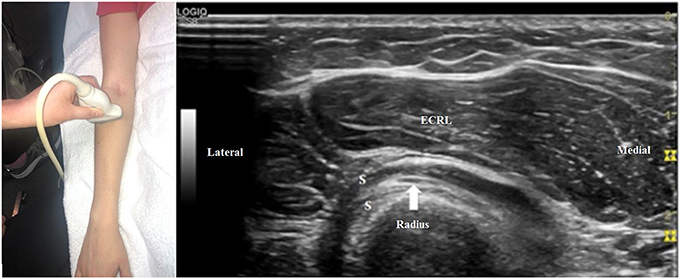 Frontiers  Ulnar Neuropathy at the Elbow: From Ultrasound Scanning to  Treatment
