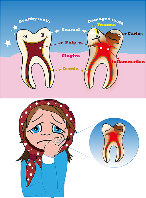 Figure 1 - A healthy tooth (left) and a tooth damaged by cavities or trauma (right).
