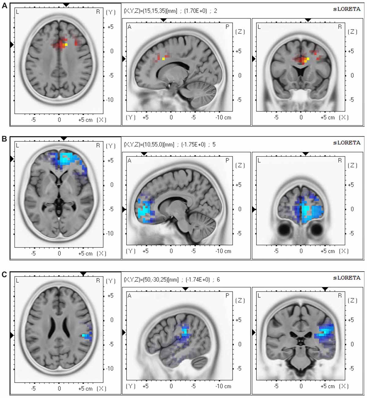 Why ECT Is Becoming a Preferred Depression Treatment