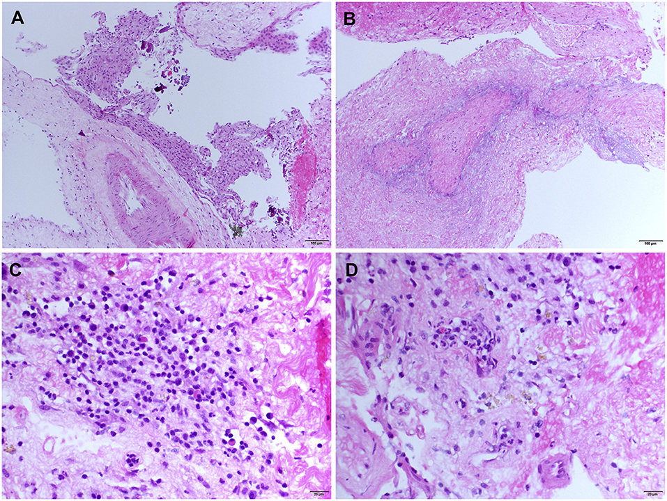 Frontiers | Rheumatoid Meningitis Presenting With Acute Parkinsonism ...