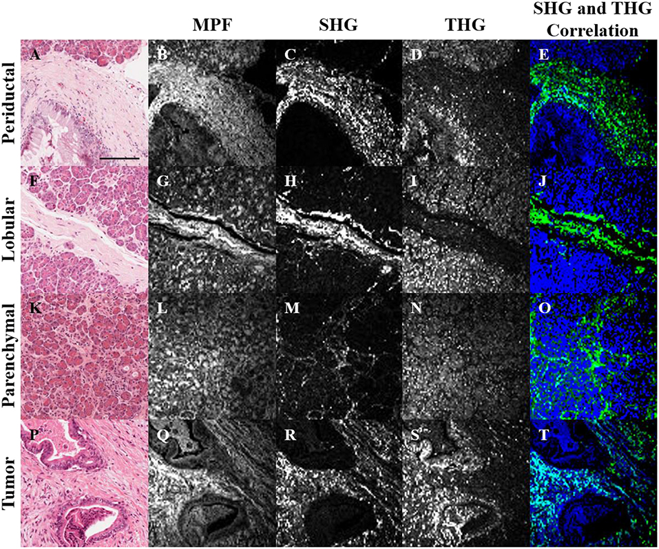 Frontiers | Characterization of Pancreatic Cancer Tissue Using 