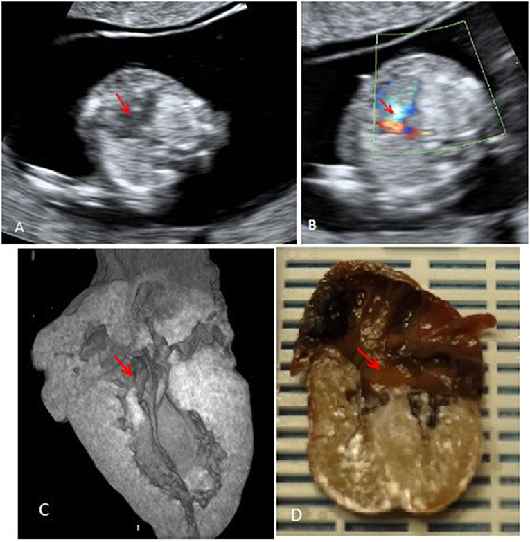 Early prenatal diagnosis of isolated anal