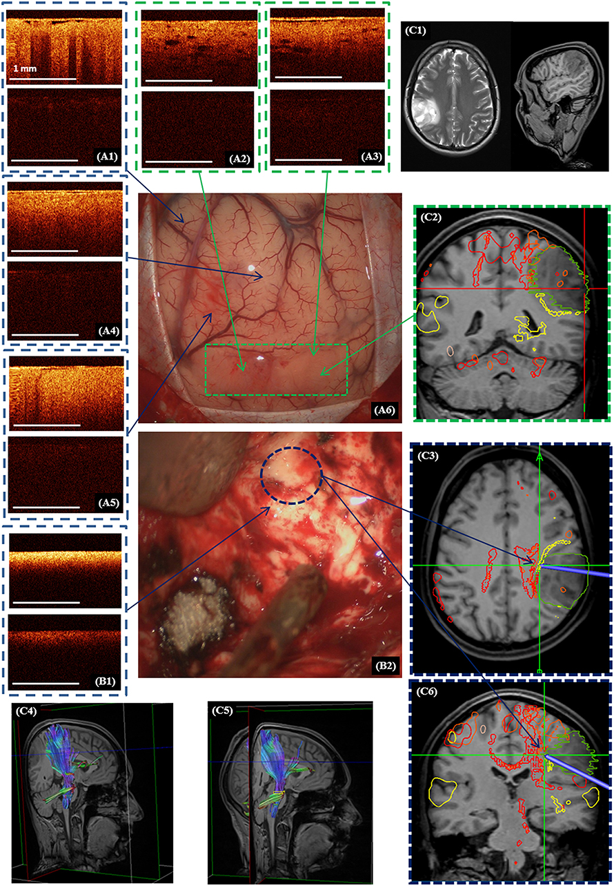 Contactless optical coherence tomography of the eyes of